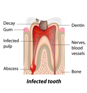 Root Canal Treatment