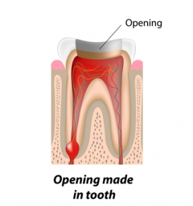 Root Canal Treatment