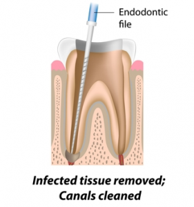 Root Canal Treatment