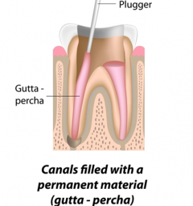 Root Canal Treatment