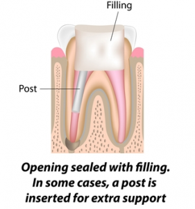 Root Canal Treatment