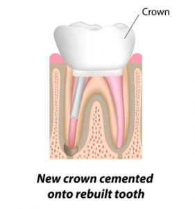 Root Canal Treatment